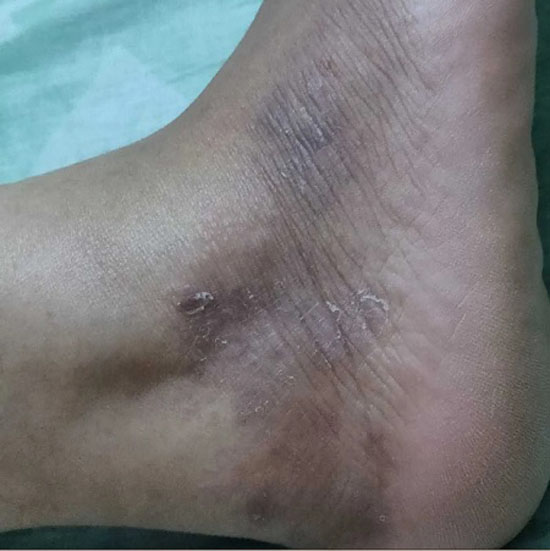 لکه های روی پوست پا چه دلایلی دارند و راه برطرف کردن آن ها
