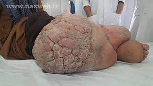 عجیب ترین بیماریهای شناخته شده پزشکی (عکس 16+)