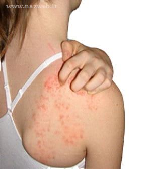 عجیب ترین بیماریهای شناخته شده پزشکی (عکس 16+)