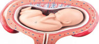 همه چیز درباره جنین عرضی در شکم مادر و راه های درمان جنین عرضی در شکم