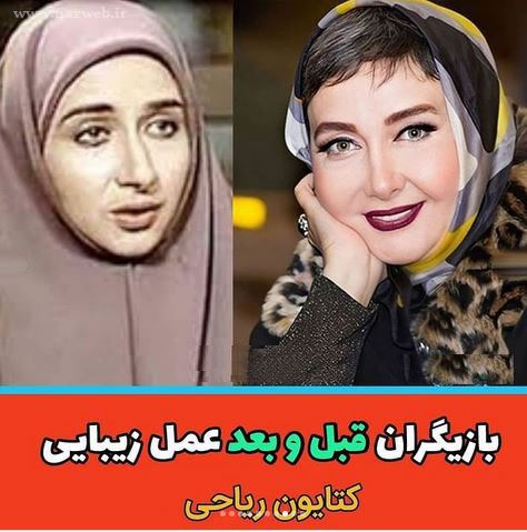 16 بازیگری که با جراحی زیبایی از این رو به اون رو شدند! + تصاویر