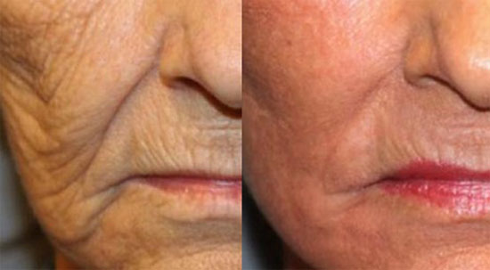 اسکارلت چیست و چه فوایدی برای پوست دارد ؟