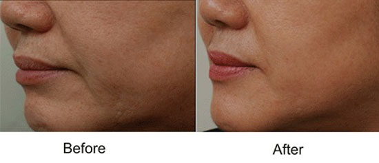 اسکارلت چیست و چه فوایدی برای پوست دارد ؟