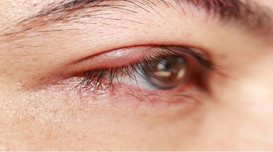 انگل دمودکس چیست و در چه پوست هایی وجود دارد؟