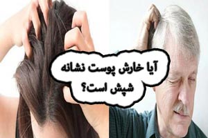 خارش سر نشانه شپش است؟ علت های خارش پوست سر خارش سر نشانه شپش است؟ علت های خارش پوست سر