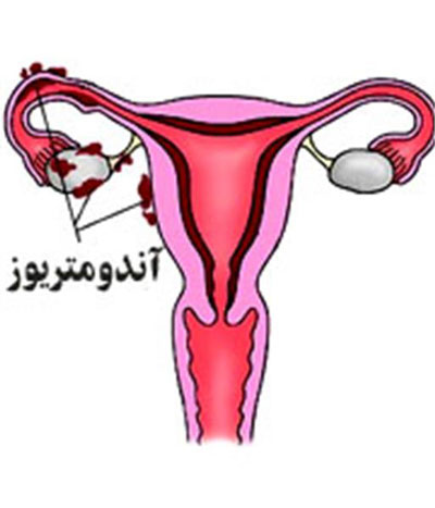 آندومتر زنان چیست؟ نشانه های آندومتر رحم و راه درمان