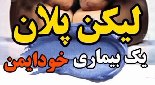لیکن پلان پوستی بیماری جدید+ از دهان تا تناسلی