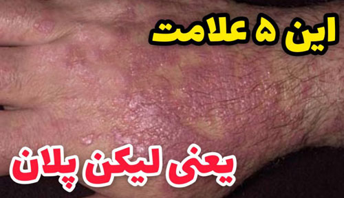 لیکن پلان پوستی بیماری جدید+ از دهان تا تناسلی