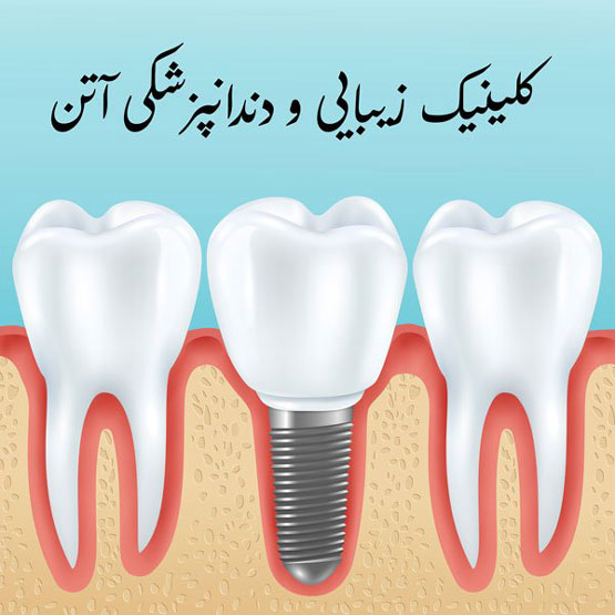 ایمپلنت دندان با شرایط پرداخت اقساط