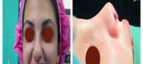 بهترین جراح بینی گوشتی را چگونه انتخاب کنیم؟+ نکات کلیدی