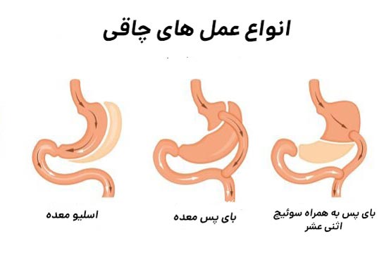 عمل های جایگزین اسلیو معده