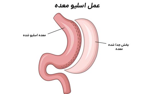 جراحی اسلیو معده