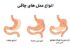 اگر این 5 ویژگی را دارید، اسلیو معده بدردتان نمی‌خورد!