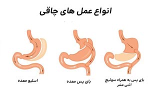 اگر این 5 ویژگی را دارید، اسلیو معده بدردتان نمیخورد! اگر این 5 ویژگی را دارید، اسلیو معده بدردتان نمیخورد!