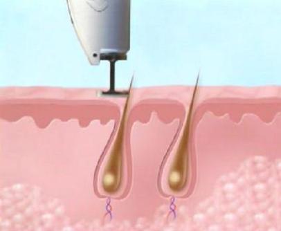 طریقه کار با لیزر و رفع موهای زائد (تصاویر)