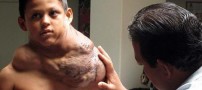 پسری با توموری وحشتناک در گردن + عکس
