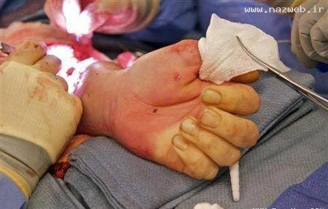 پیوند 2 دست یک جنازه به یک انسان زنده ! +عکس