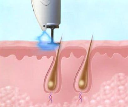 طریقه کار با لیزر و رفع موهای زائد (تصاویر)