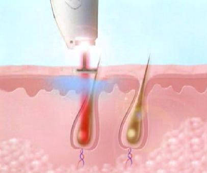 طریقه کار با لیزر و رفع موهای زائد (تصاویر)