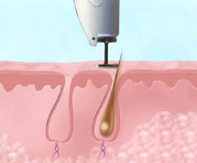 طریقه کار با لیزر و رفع موهای زائد (تصاویر)