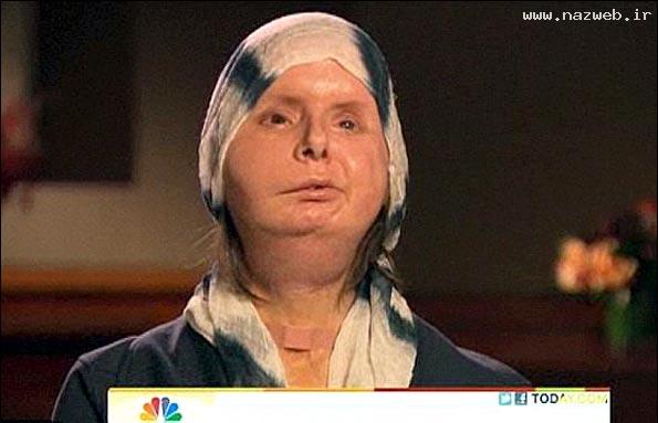 عکس های دیدنی چهره زنی پس از پیوند صورت