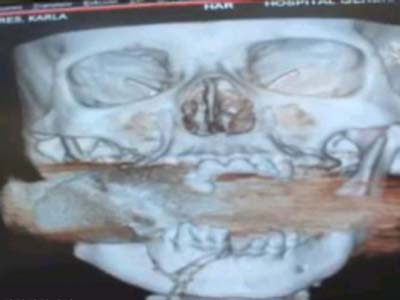 خروج نارنجک منفجر نشده از صورت این زن
