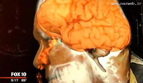 مرد عجیبی که مغزش از بینی اش چکه می کند!! عکس