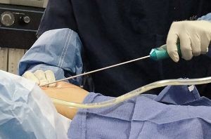 چه افرادی نمی توانند لیپوساکشن کنند