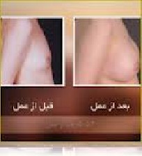 بهترین سن برای پروتز کردن سینه ها
