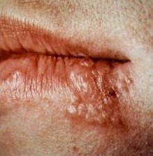 افراد مبتلا به تبخال بخوانند