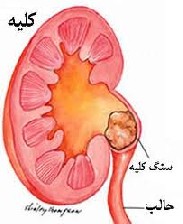 سنگ کلیه از چیست و چرا سنگ می گیریم