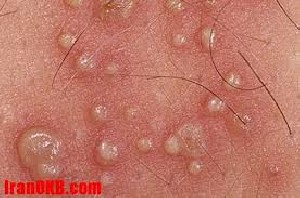 علائم تبخال دستگاه تناسلی علائم تبخال دستگاه تناسلی