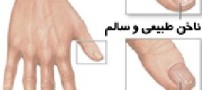 هر مشکلی روی ناخن ها نشانه چیست