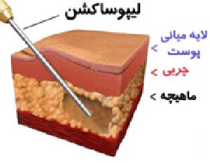 لیپوساكشن هیچ فایده ای ندارد زیرا… لیپوساكشن هیچ فایده ای ندارد زیرا…