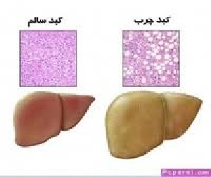 بیماری کبد چرب چیست