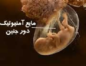 دلیل و خطر زیاد شدن مایع آمنیوتیک دور جنین دلیل و خطر زیاد شدن مایع آمنیوتیک دور جنین