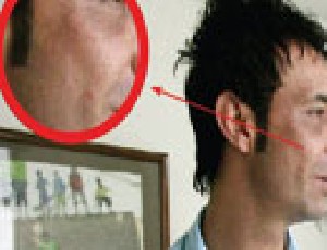 انواع جراحی های زیبایی در بازیکنان مشهور فوتبال ایران انواع جراحی های زیبایی در بازیکنان مشهور فوتبال ایران