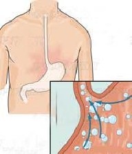 دلیل سوزش دلمان چیست