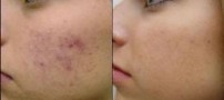 راه های از بین بردن جای جوش