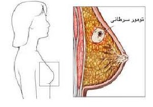 روش های شناسایی سرطان سینه
