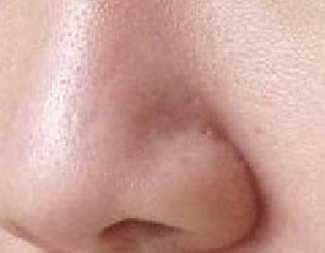 راهکار برای منافذ باز پوست صورت